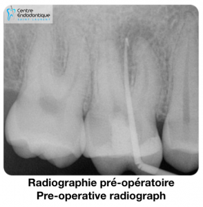 Radiographie pré-opératoire / Pre-operative radiograph