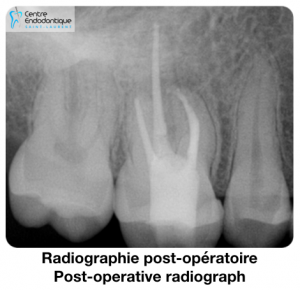 Radiographie post-opératoire / Post-operative radiograph